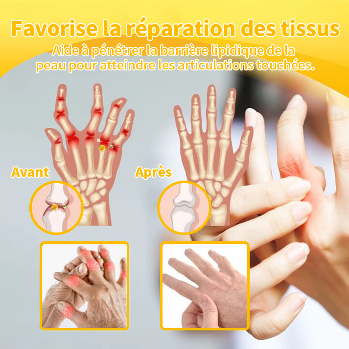 Aeehfeng™ Venin d'abeille et curcuma Crème de traitement de l'arthrite (👨‍⚕️ Spécialisé dans les affections orthopédiques et les douleurs articulaires 💖)