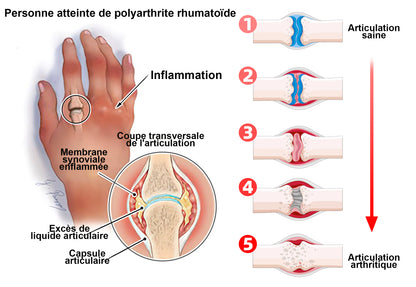 ArthroEase Bee Venom Joint and Bone Arthritis Therapy Cream⭐(Spécialement pour les personnes âgées et recommandé par l'AAOS)