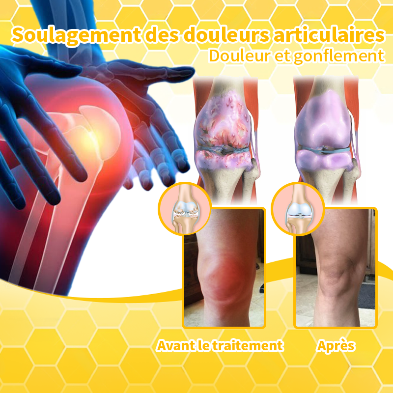 Aeehfeng™ Venin d'abeille et curcuma Crème de traitement de l'arthrite (👨‍⚕️ Spécialisé dans les affections orthopédiques et les douleurs articulaires 💖)